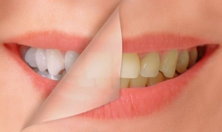 Unveiling the Brilliance: The Art and Science of Near Me Teeth Whitening